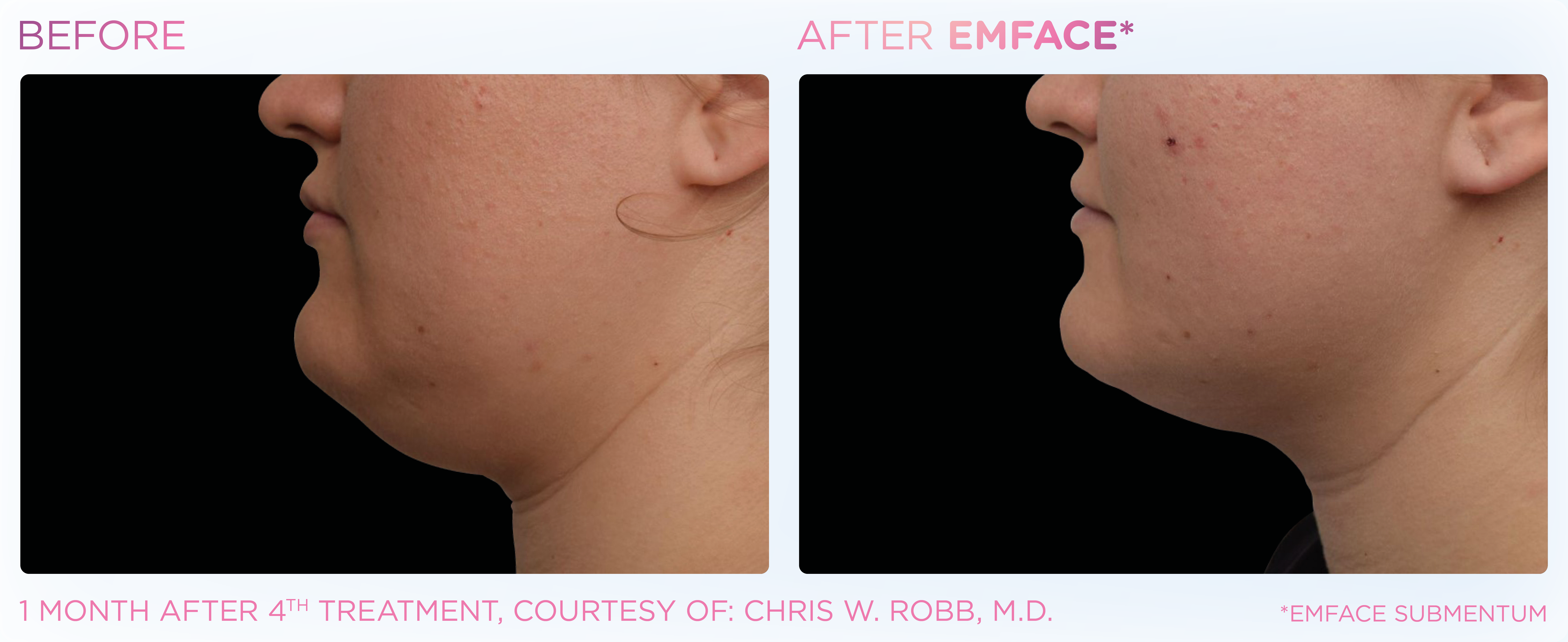 Double Chin Treatment, manufacturer before-and-after example 6; before on the left and after on the right