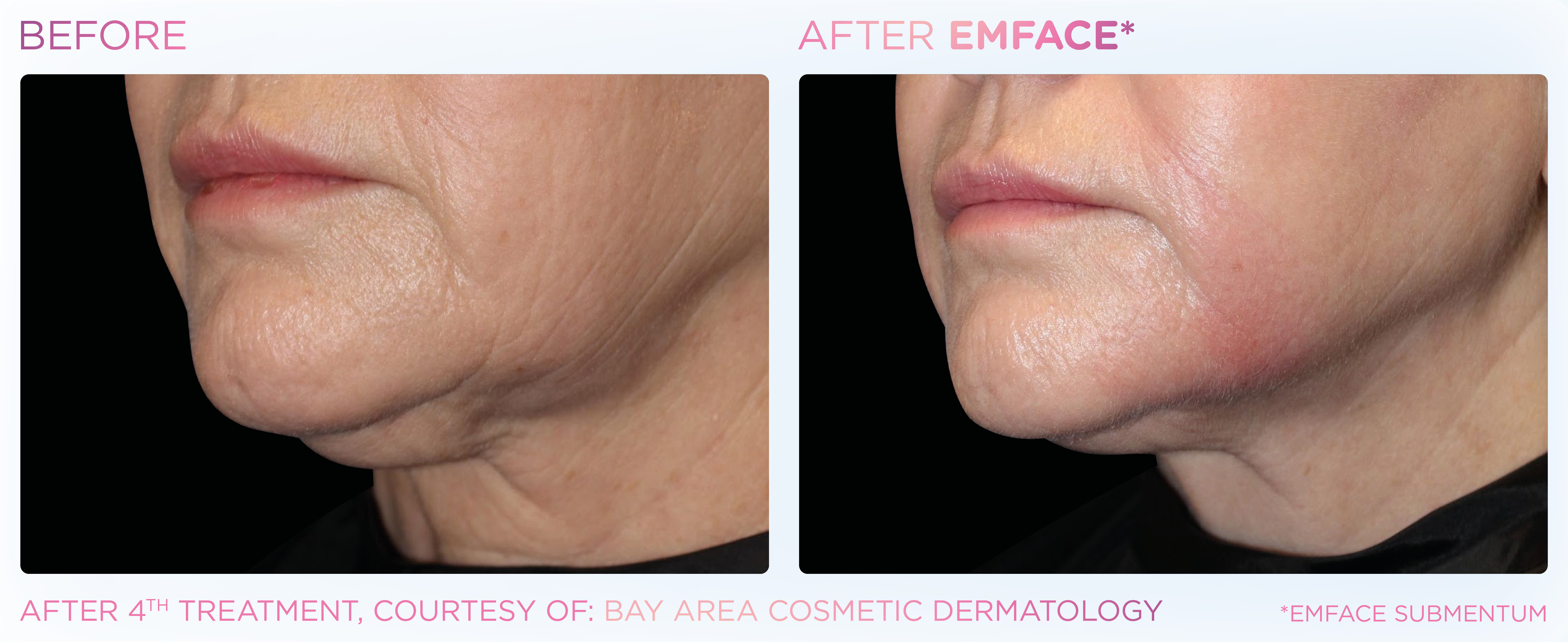 Double Chin Treatment, manufacturer before-and-after example 7; before on the left and after on the right