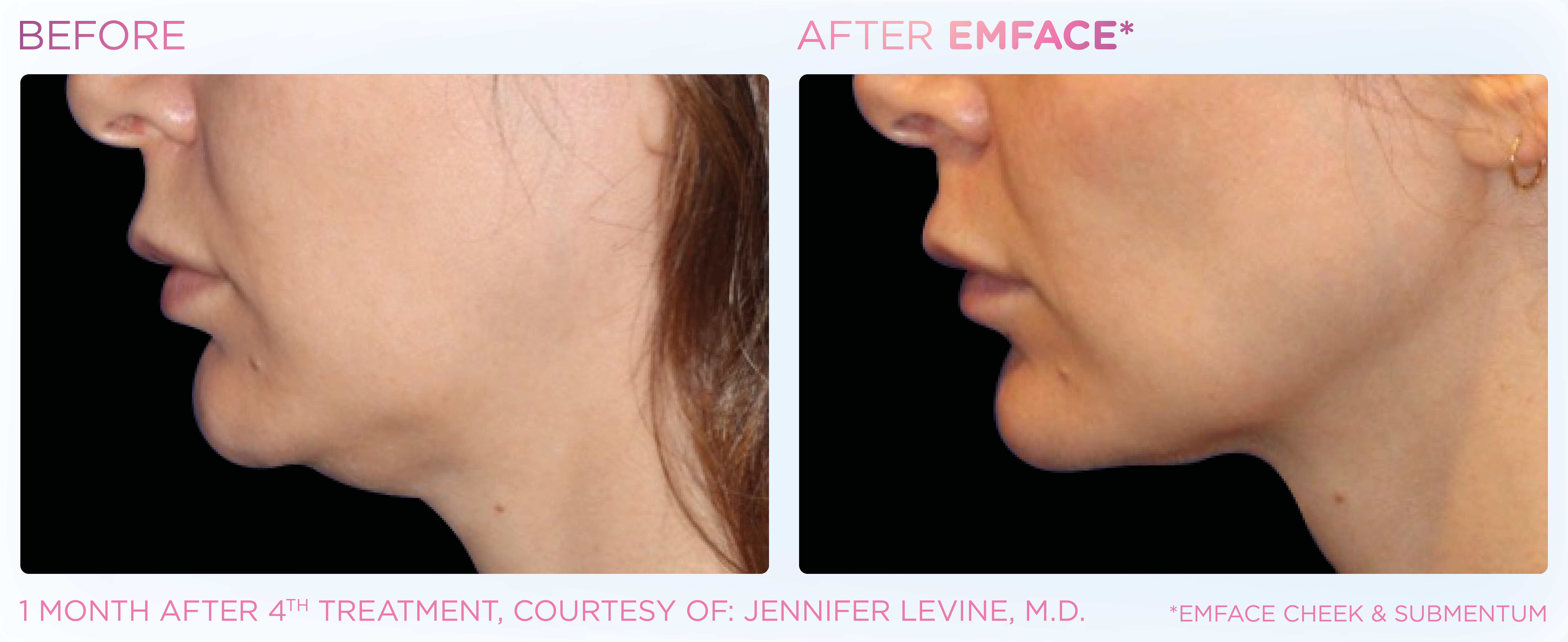 Double Chin Treatment, manufacturer before-and-after example 8; before on the left and after on the right