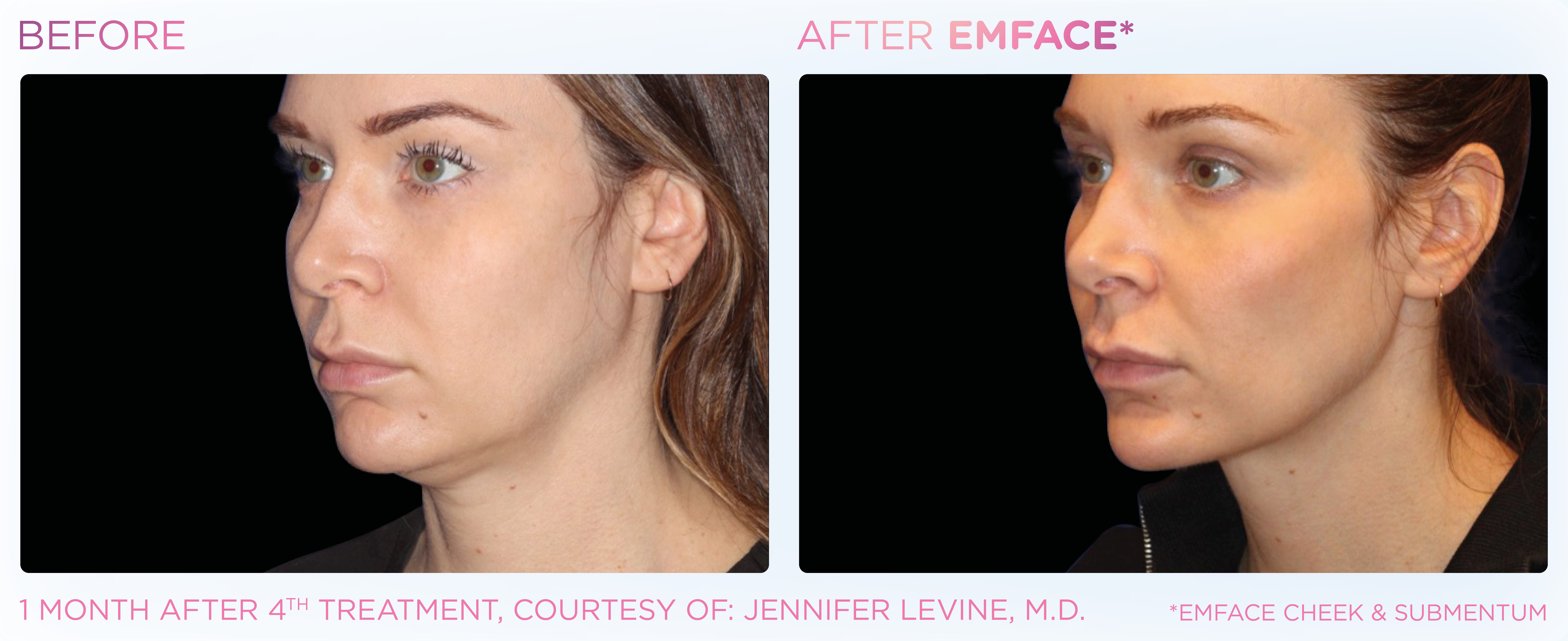 Double Chin Treatment, manufacturer before-and-after example 9; before on the left and after on the right