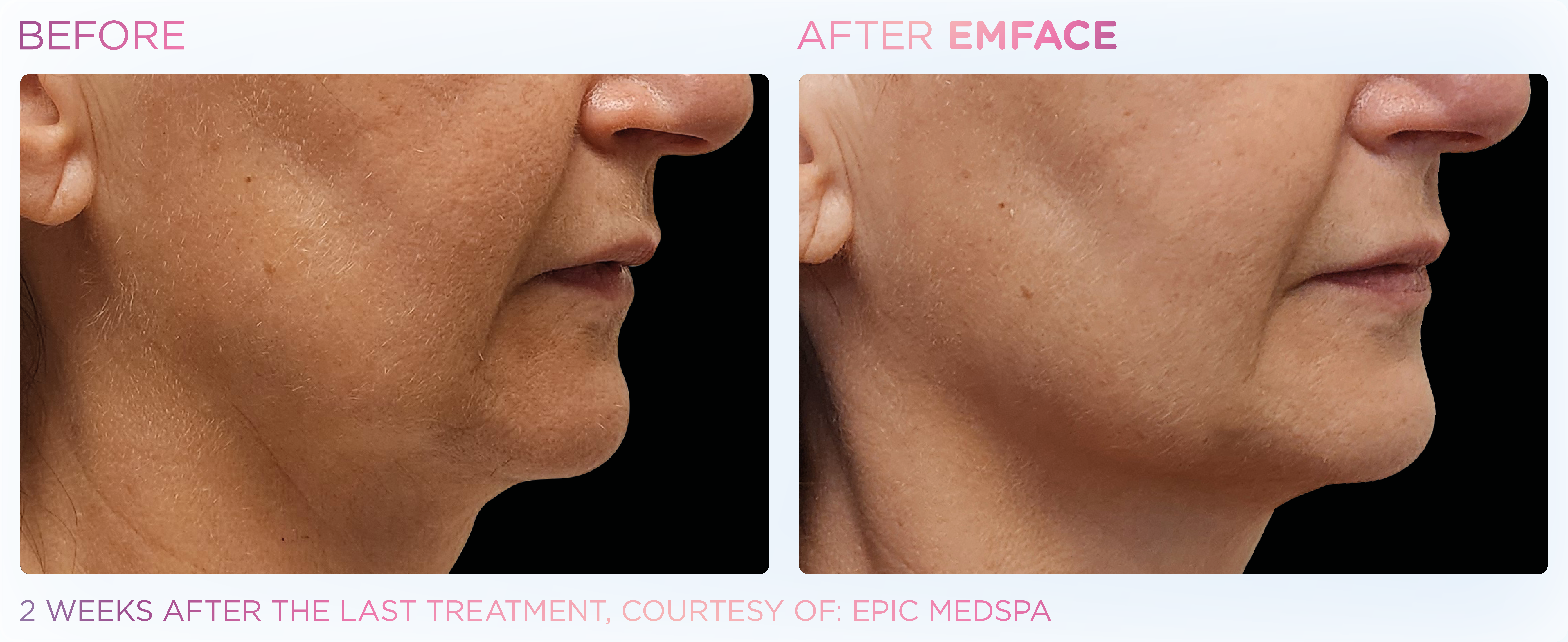 Jawline Contouring, manufacturer before-and-after example 8; before on the left and after on the right