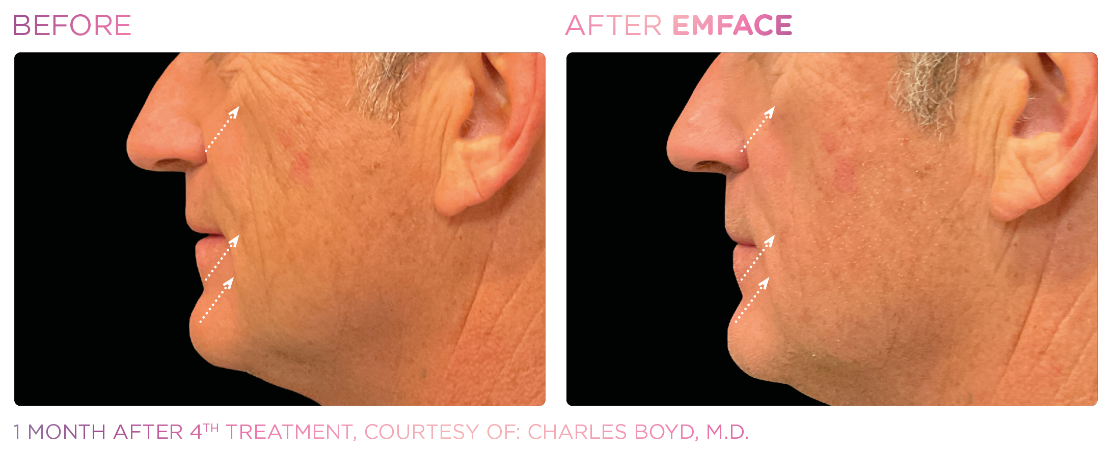 Facial Rejuvenation, manufacturer before-and-after example 28; before on the left and after on the right