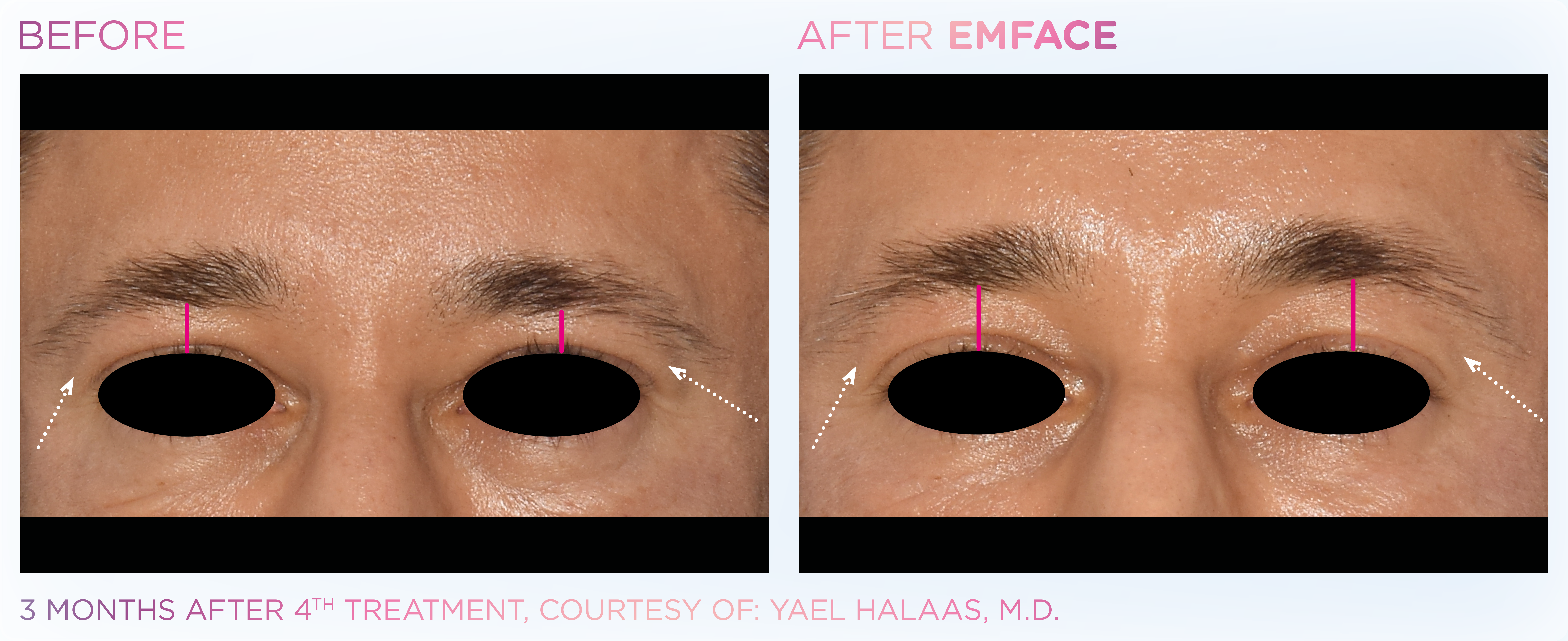 Facial Rejuvenation, manufacturer before-and-after example 29; before on the left and after on the right
