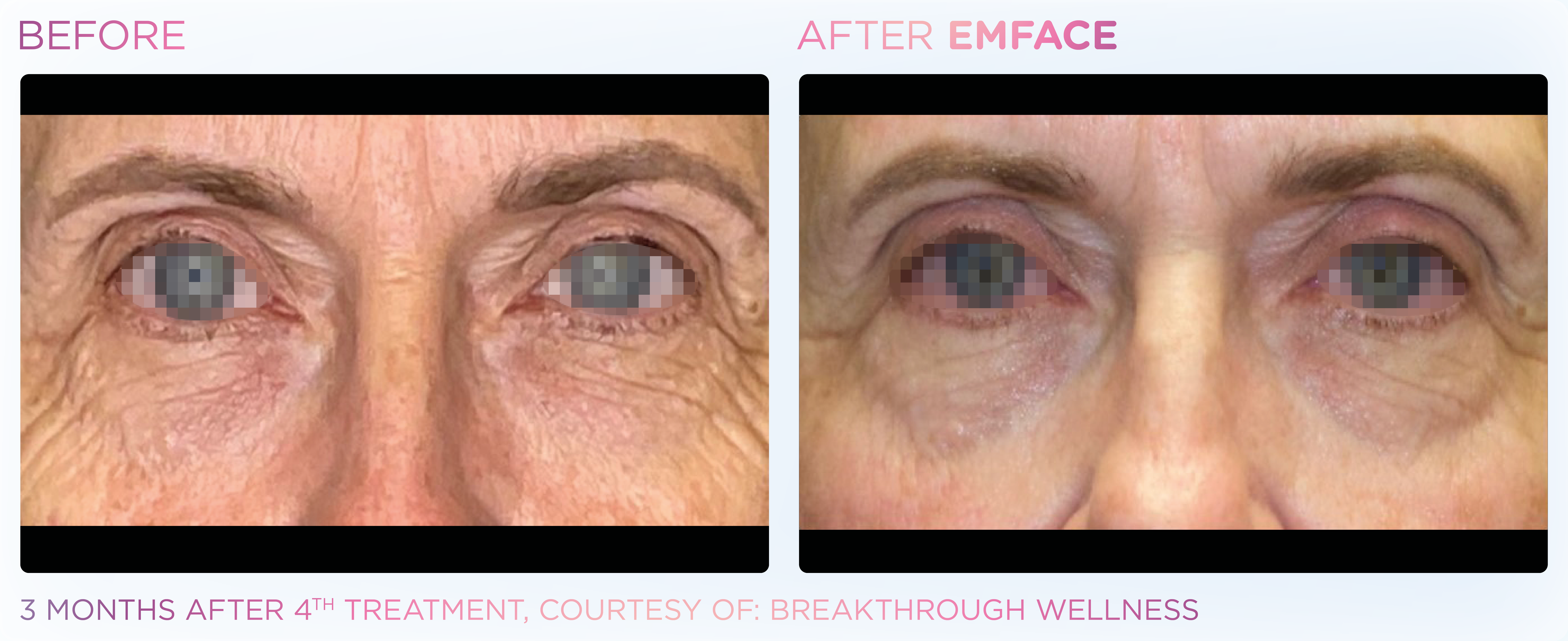 Under-Eye Treatment, manufacturer before-and-after example 12; before on the left and after on the right