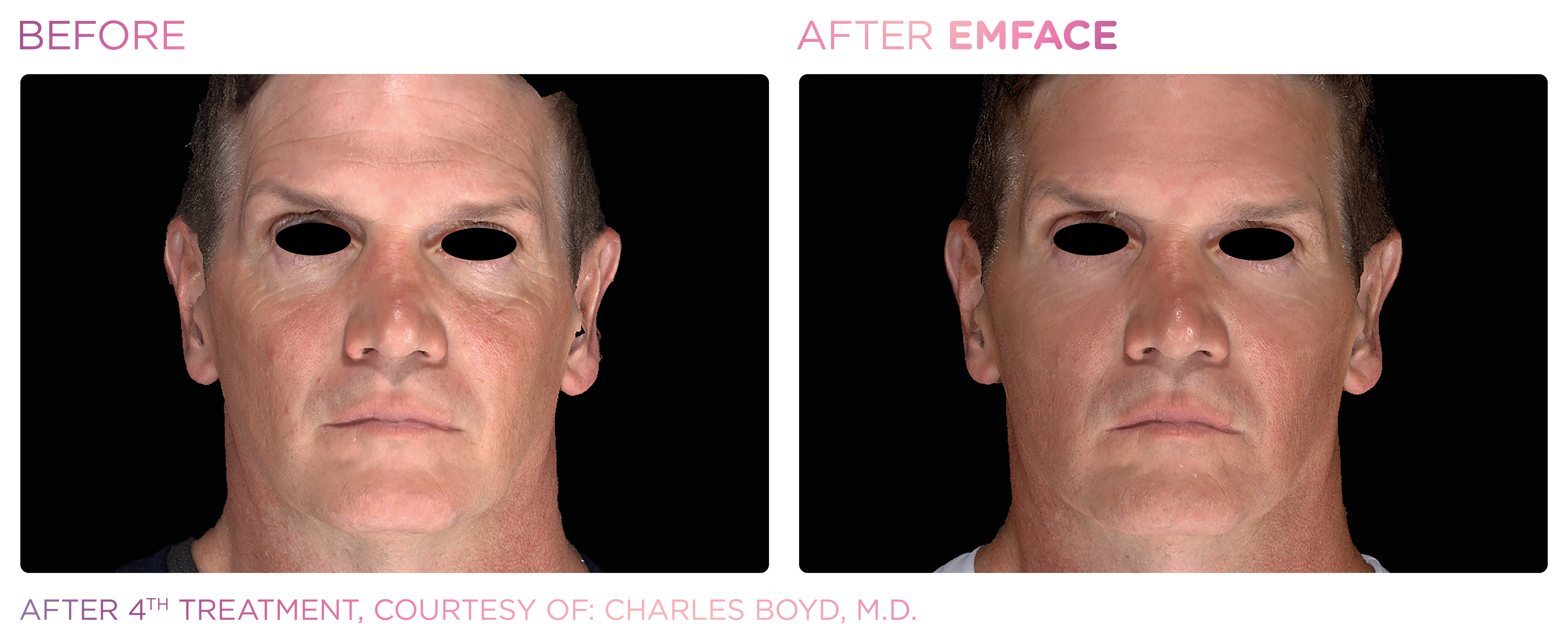 Facial Rejuvenation, manufacturer before-and-after example 30; before on the left and after on the right