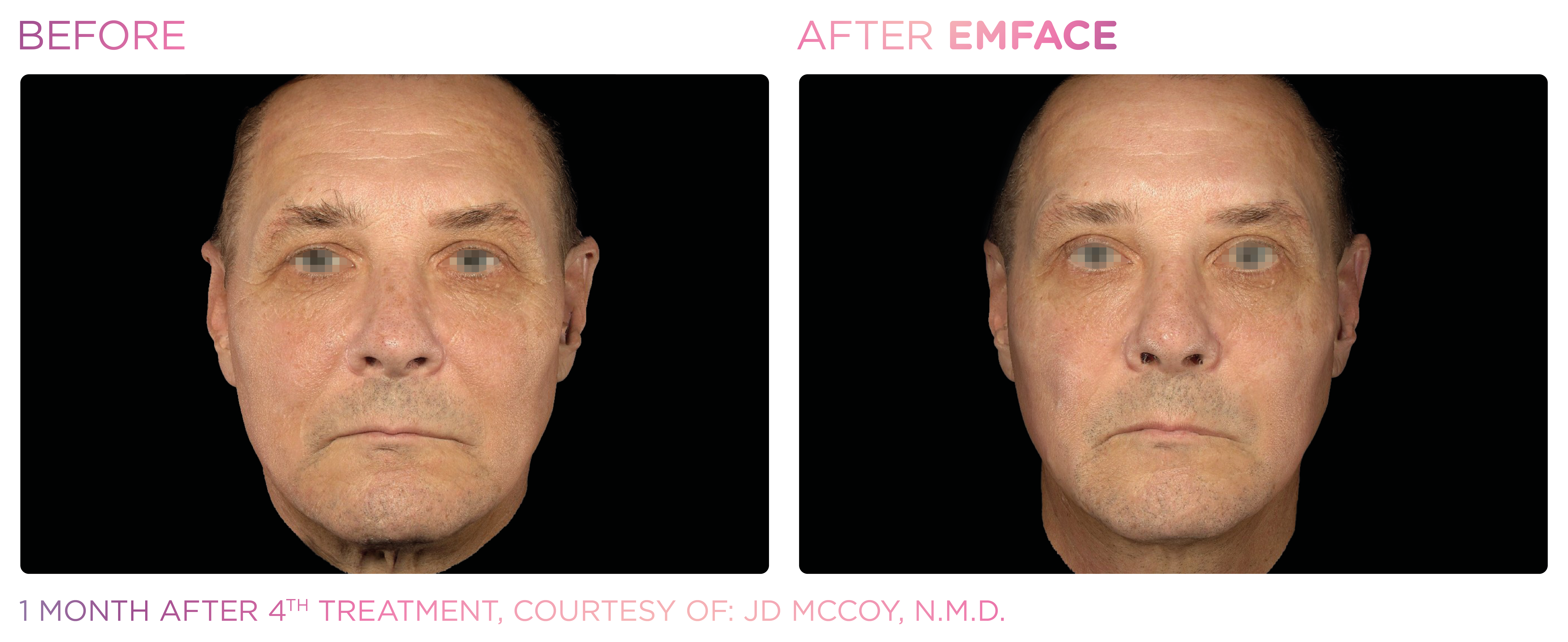 Facial Rejuvenation, manufacturer before-and-after example 31; before on the left and after on the right