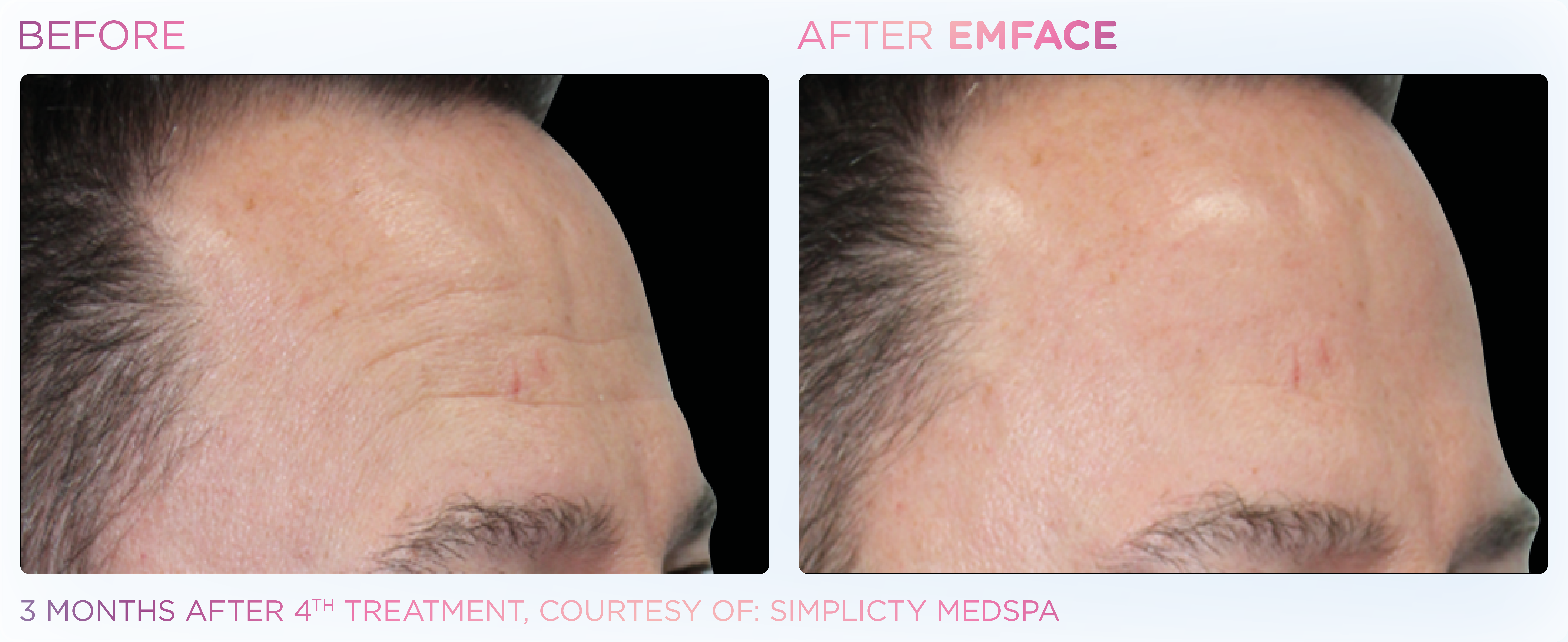 Facial Rejuvenation, manufacturer before-and-after example 32; before on the left and after on the right