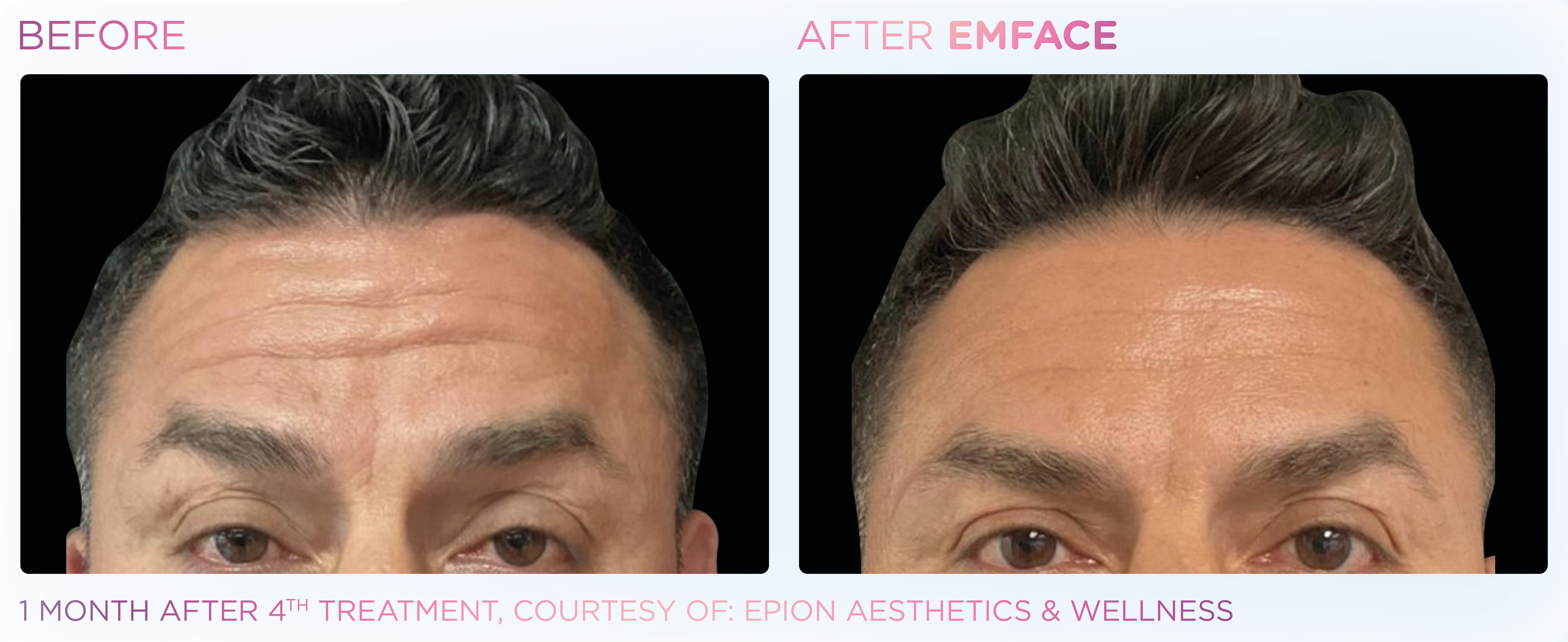 Facial Rejuvenation, manufacturer before-and-after example 33; before on the left and after on the right