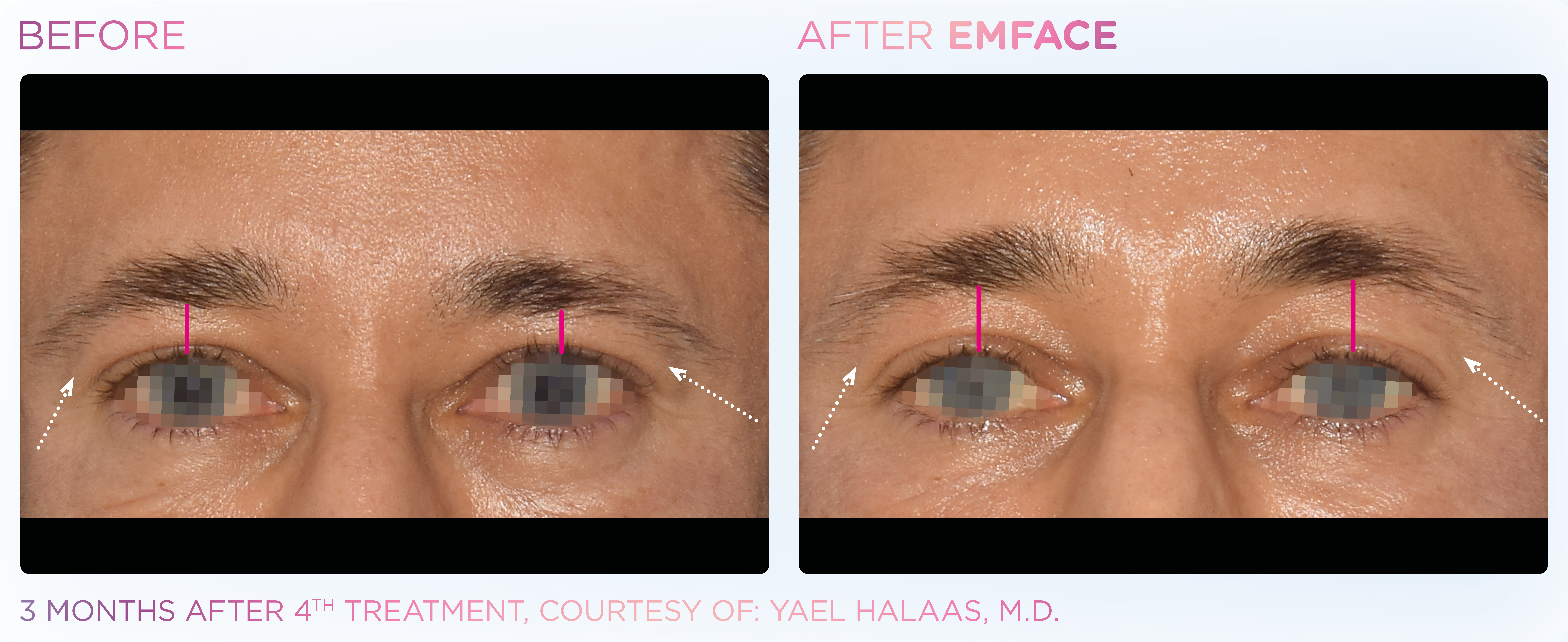 Facial Rejuvenation, manufacturer before-and-after example 34; before on the left and after on the right