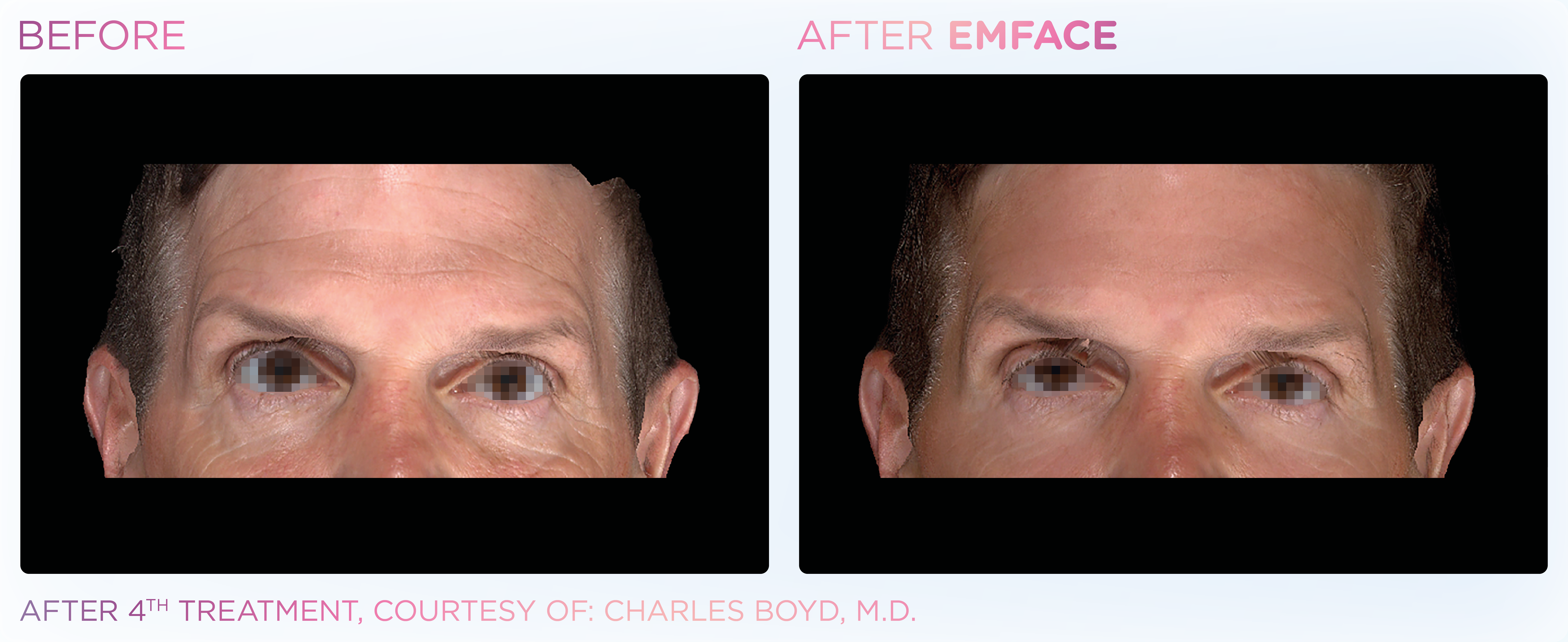 Facial Rejuvenation, manufacturer before-and-after example 35; before on the left and after on the right