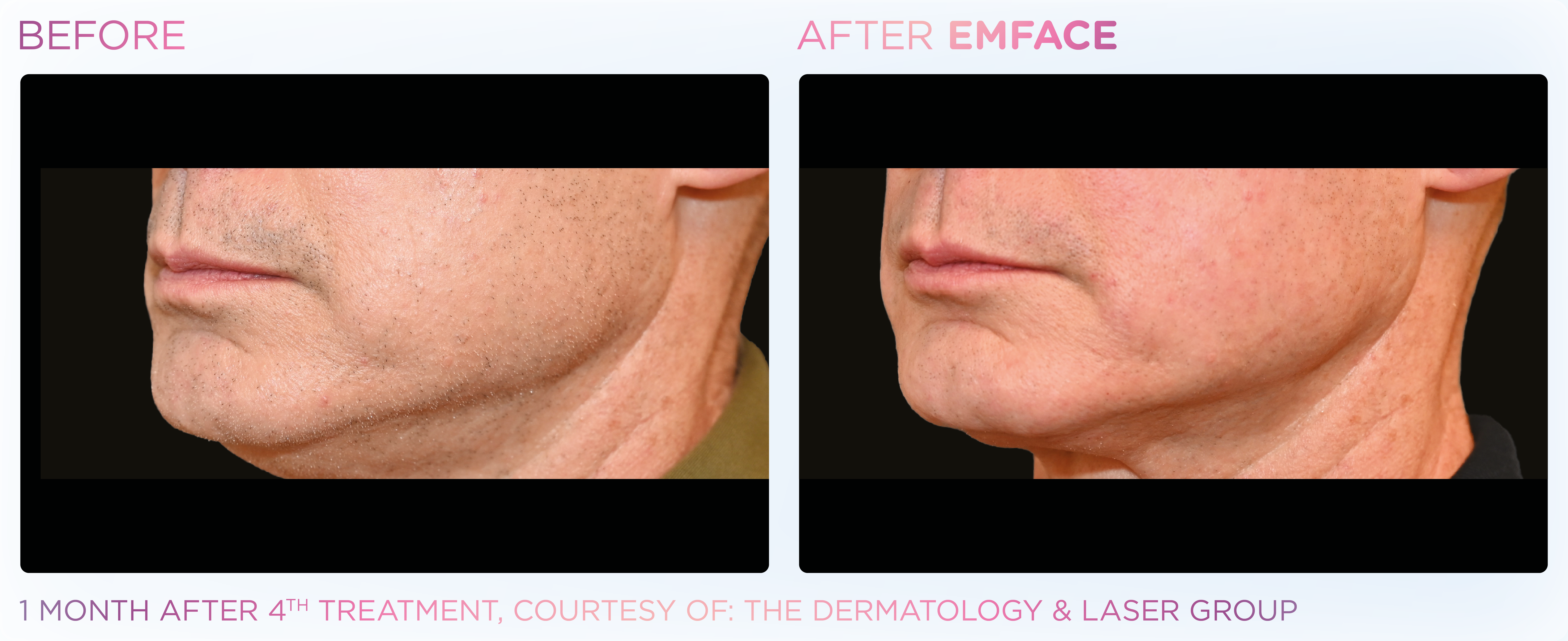 Jawline Contouring, manufacturer before-and-after example 9; before on the left and after on the right