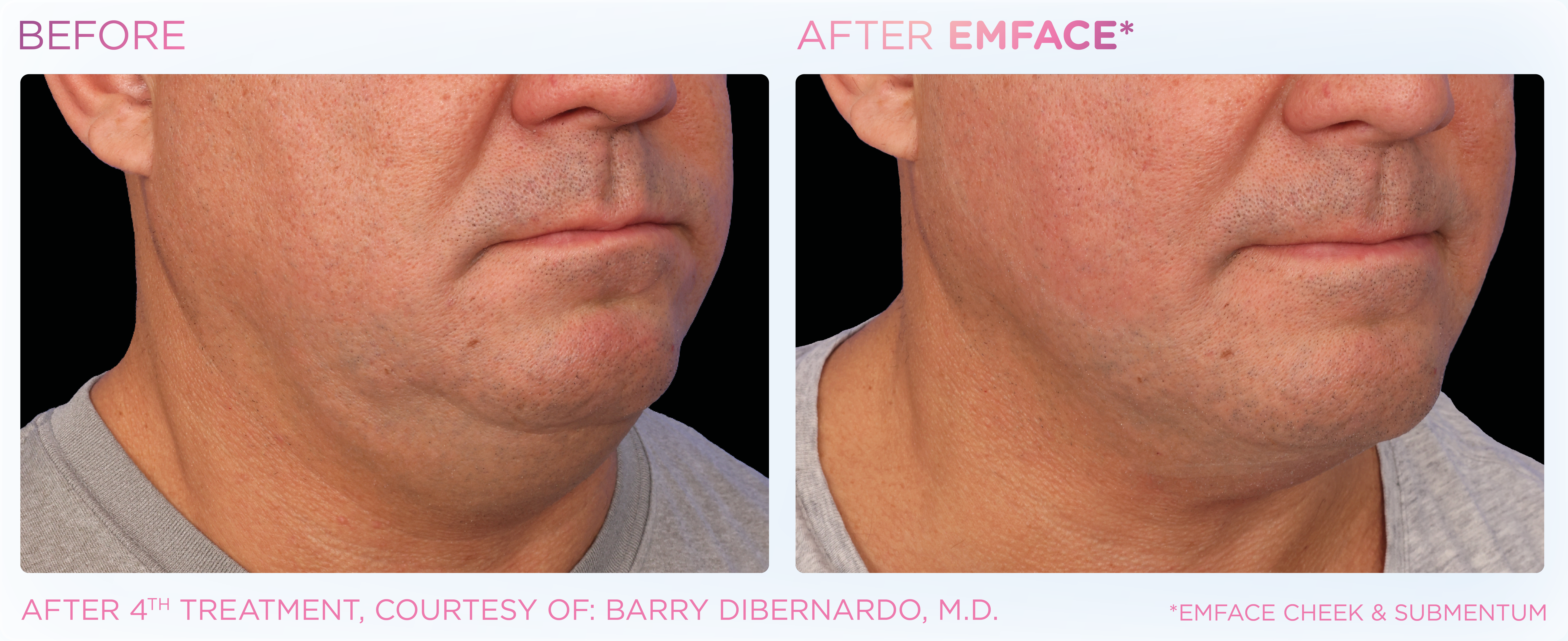 Double Chin Treatment, manufacturer before-and-after example 10; before on the left and after on the right