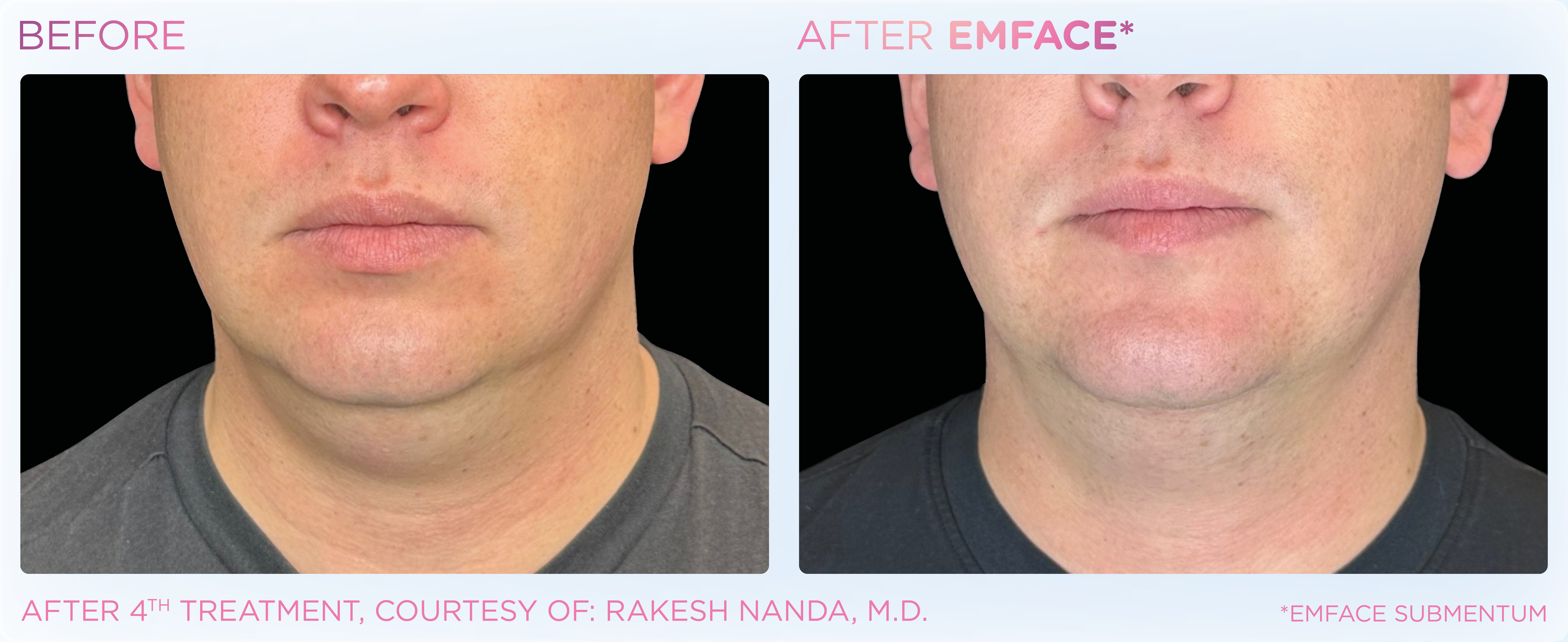 Double Chin Treatment, manufacturer before-and-after example 11; before on the left and after on the right